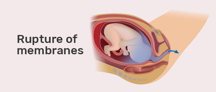 Assisted Rupture Of Membranes Dr Dan Elly Aniku - OBGYN Physician