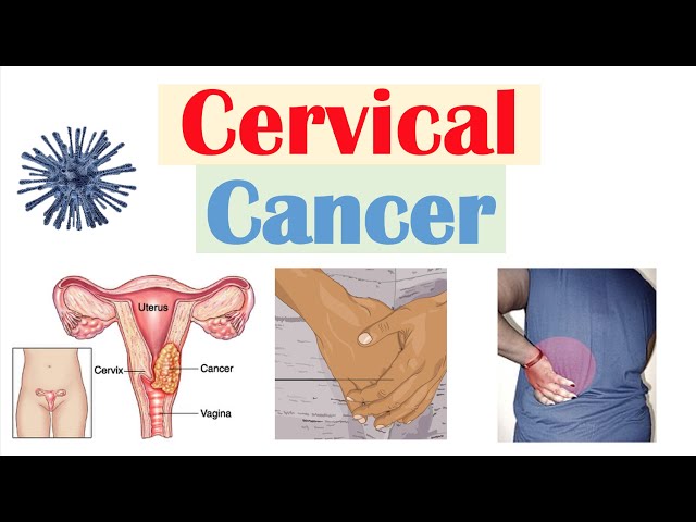 The Role of HPV Vaccines in Preventing Cervical Cancer